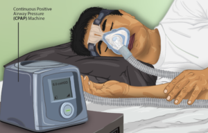 depiction of a person sleeping using a CPAP machine